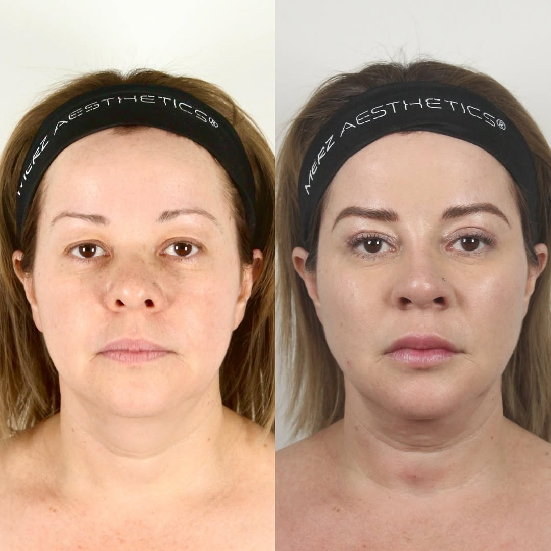 Antes y después — armonización facial con protocolo Merz